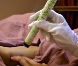 Moxibustion
