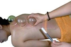 Chinese Fire Cupping